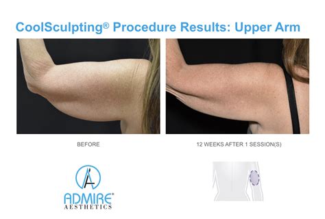 coolsculpting results timeline|Tracking CoolSculpting Results .
